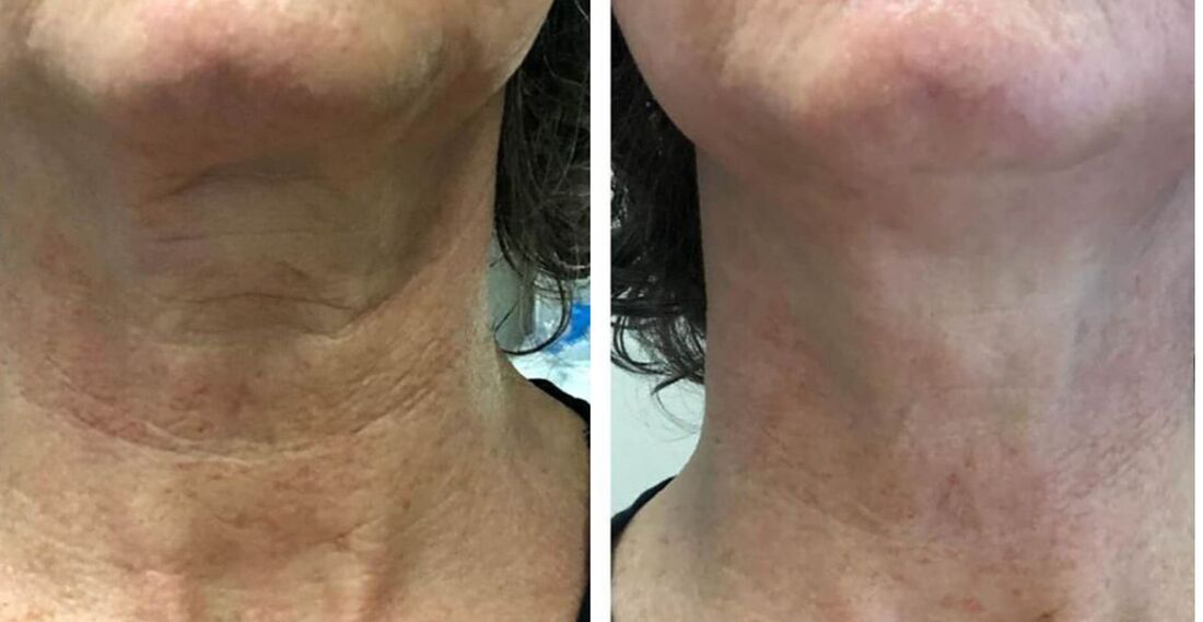 RF Microneedling in Wilmington, NC | Near Me | Wrightsville Beach