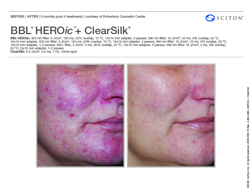 BBL HEROic+ClearSilk_(binder)