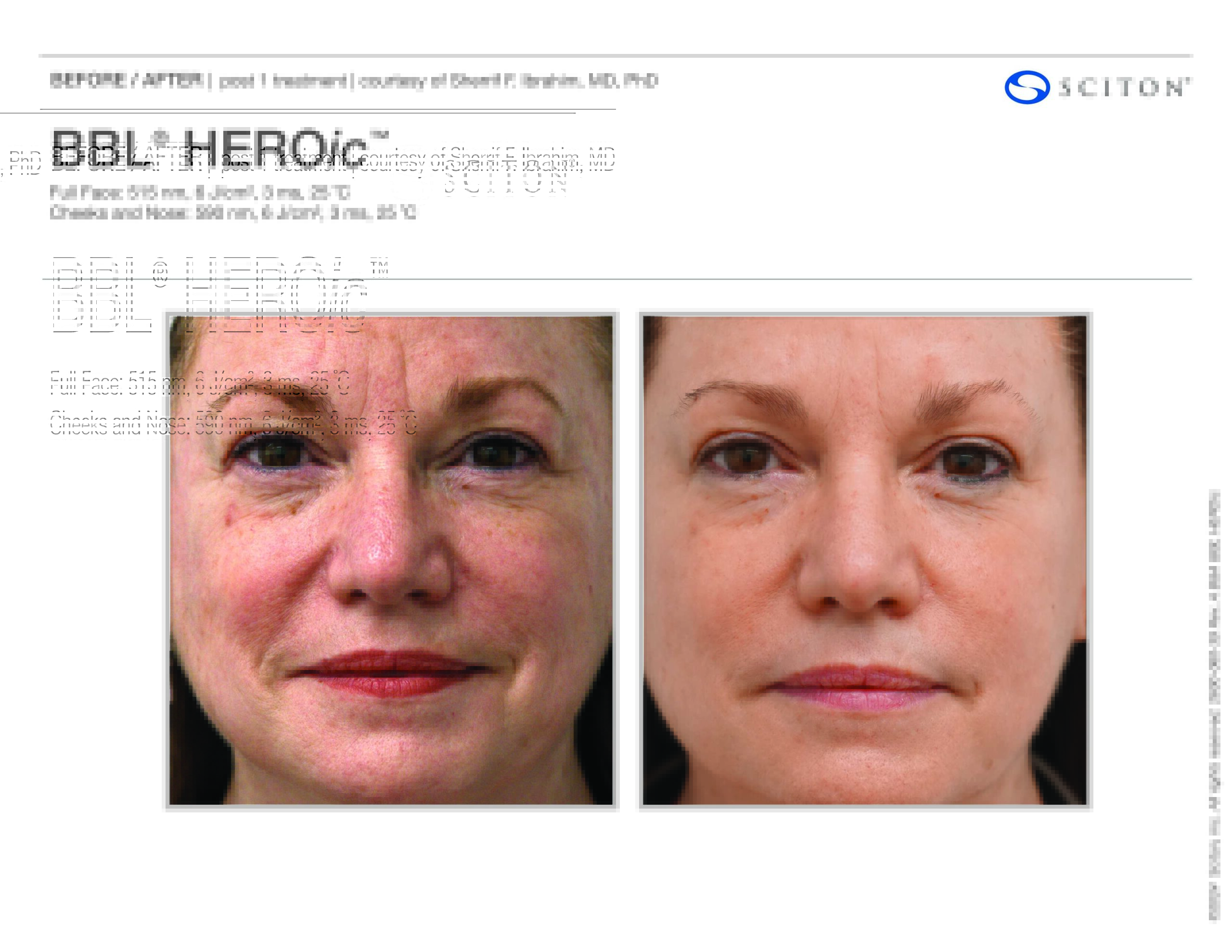 BBL HEROic - Before and After Image - 2600-060-39 Rev A B_A Photos, BBL HEROic Face _(binder)
