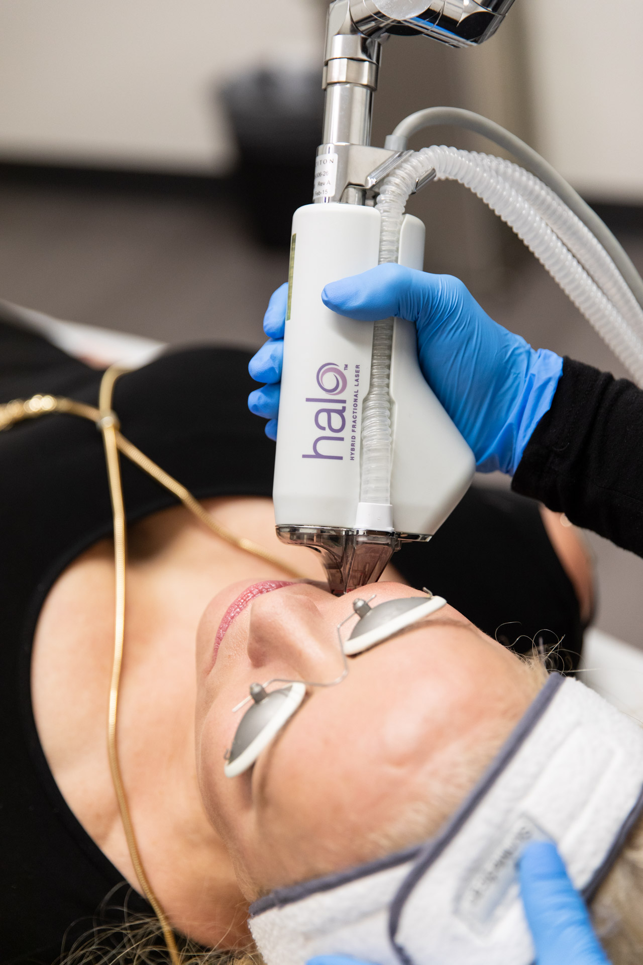 halo lazer treatment 